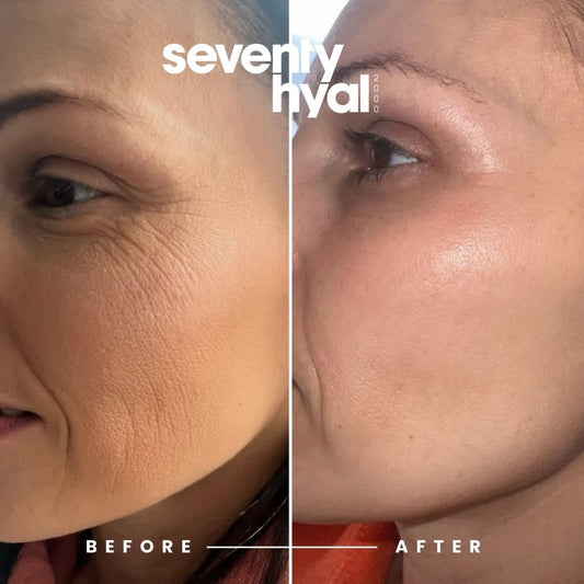 The Glow-Up Trio: Seventy Hyal 2000, Skin Peels, and Botox